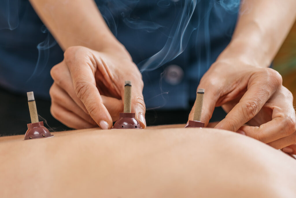 Moxibustion Therapy – Traditional Chinese Medicine