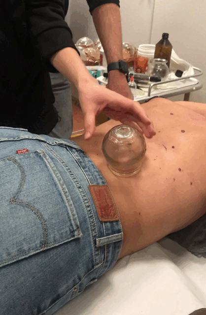 Coppettazione in vetro con calore