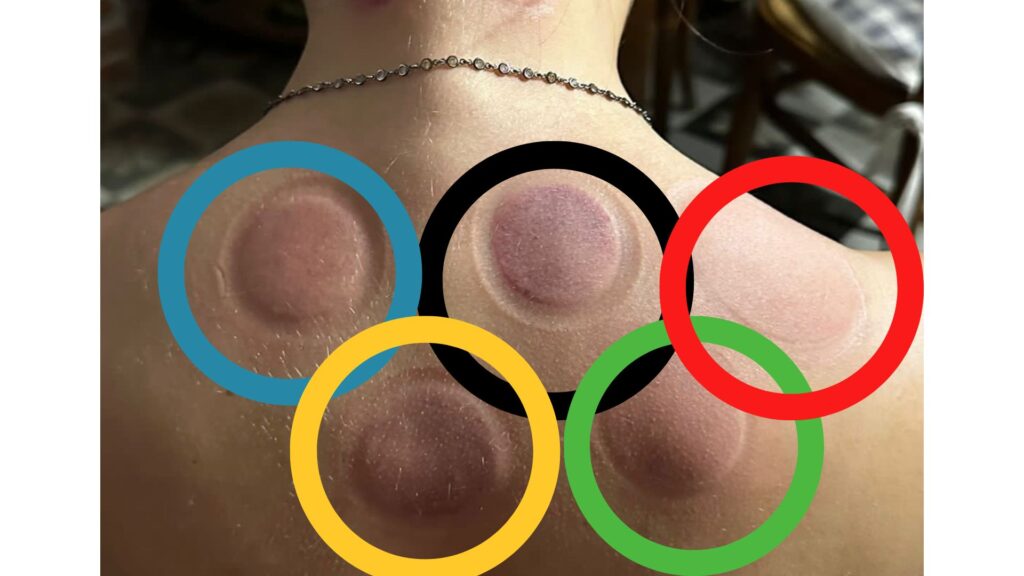 Olimpiadi e misteriosi cerchi scuri sulla pelle degli atleti: la coppettazione in MTC